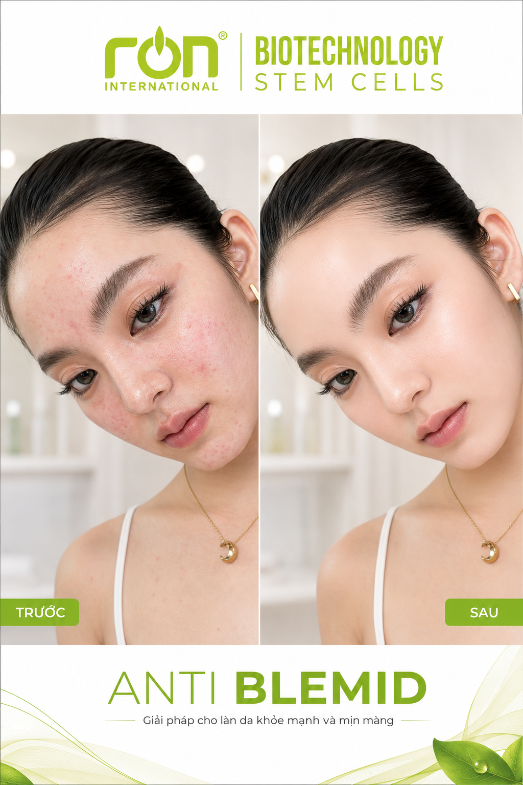 DR.BEFACE ANTI BLEMID ACNE 5ML – TINH CHẤT CHĂM SÓC DA DẦU, DA DỄ NỔI MỤN – 5ml/lọ